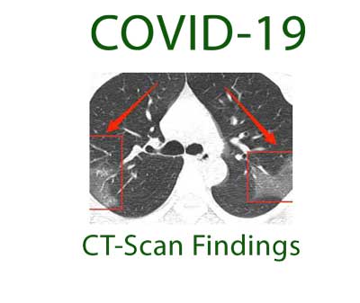 یافته های سی تی اسکن بیماران کووید19